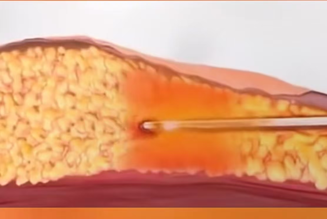 OPTIC FIBER ANTI-AGING